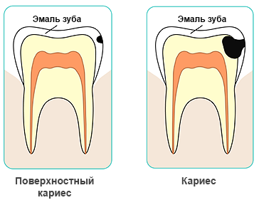 Кариес